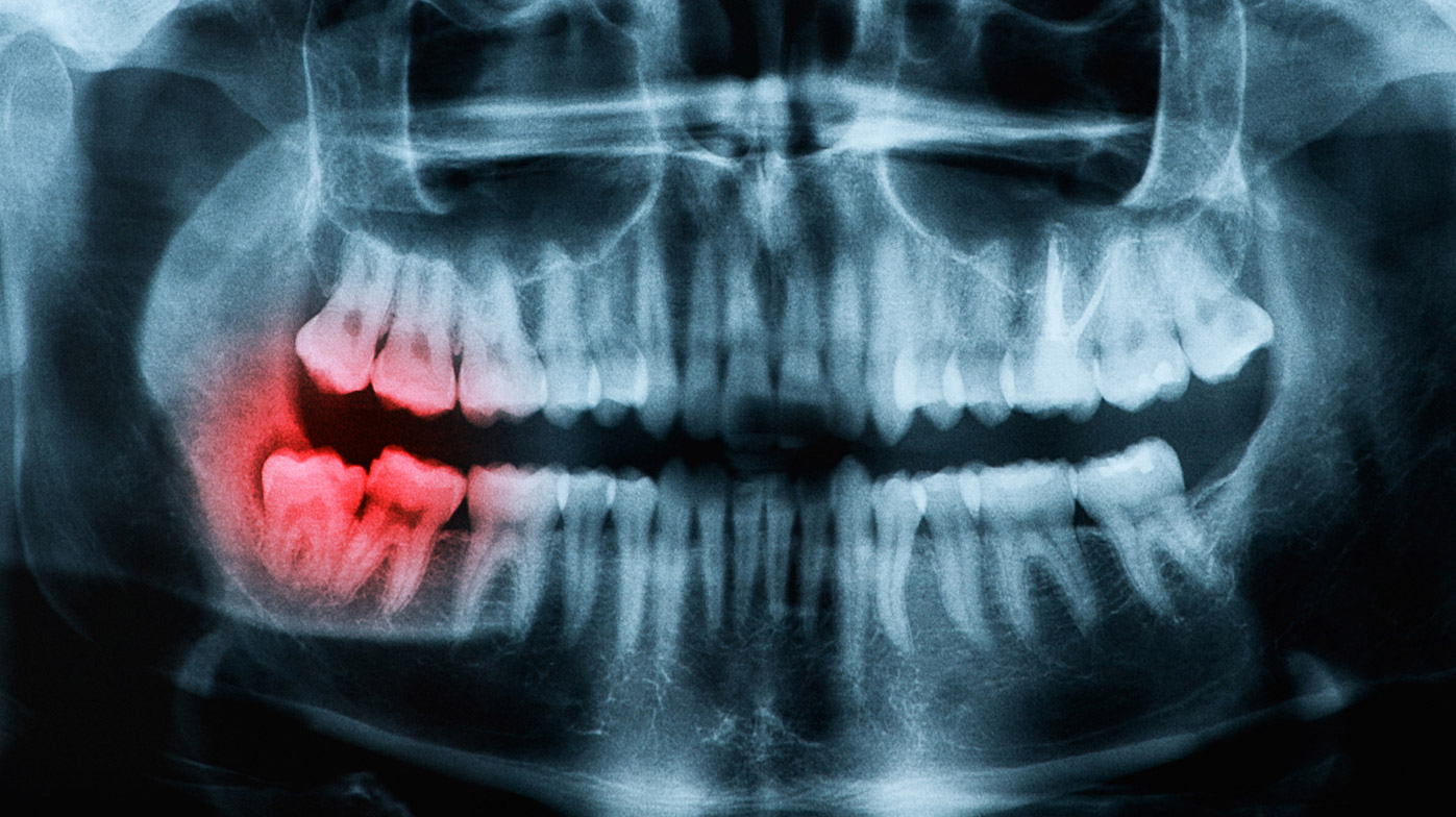 Extracción de muelas del juicio Van Nuys Victory Dental Van Nuys