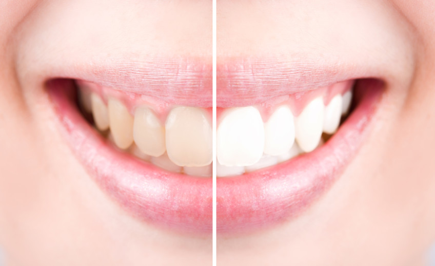 Close-up teeth female between before and after whitening the teeth.